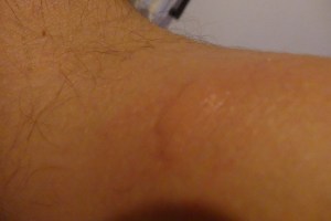 Picadura de mosquito tailandes